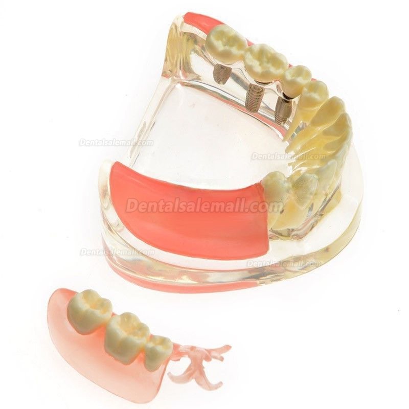 Dental Model Contrast Implant Restoration for Missing Molar Teeth M-6006