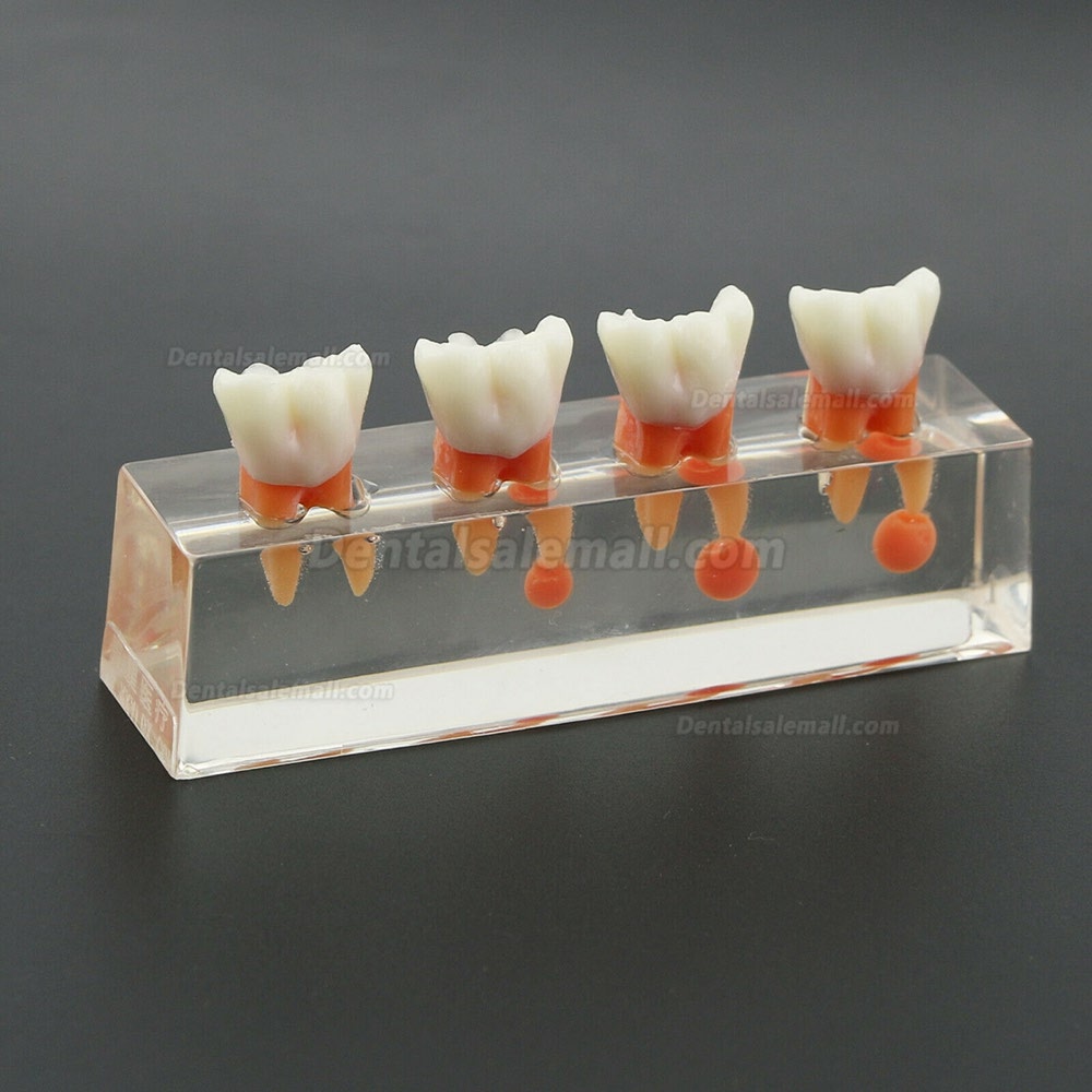 Dental Teeth Model 4-Stage Endodontic Treatment Demonstrates Anatomical M4018