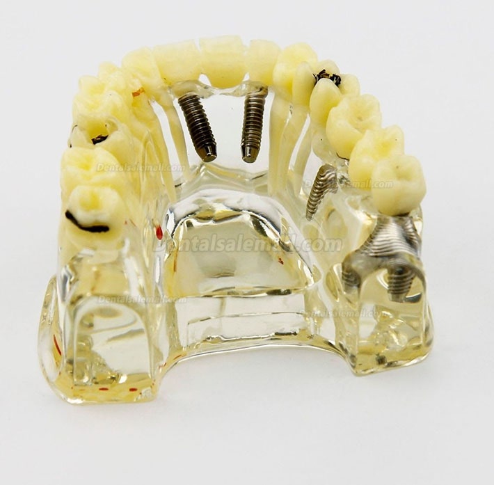 Dental Upper Jaw Implant Model with Bridge and Caries -I 2006