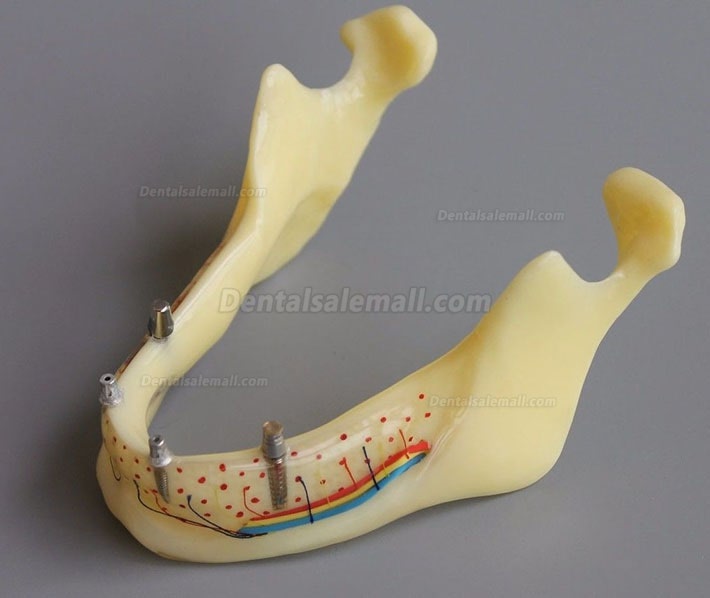 Dental Model #2014 02 - Mandible Implant and Overdenture Demo Model (Yellow)