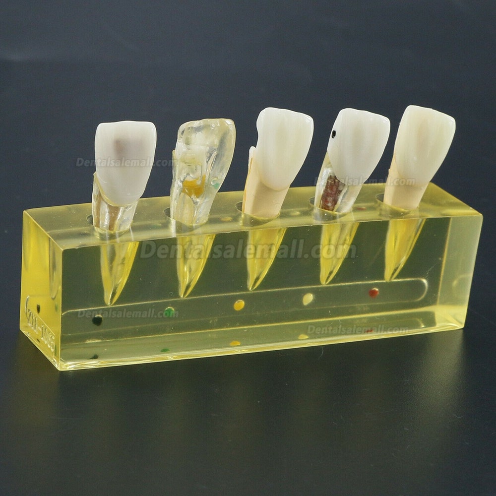 Dental Teeth Model 5Stages Demonstration Endodontic Treatment Root Canal Incisor