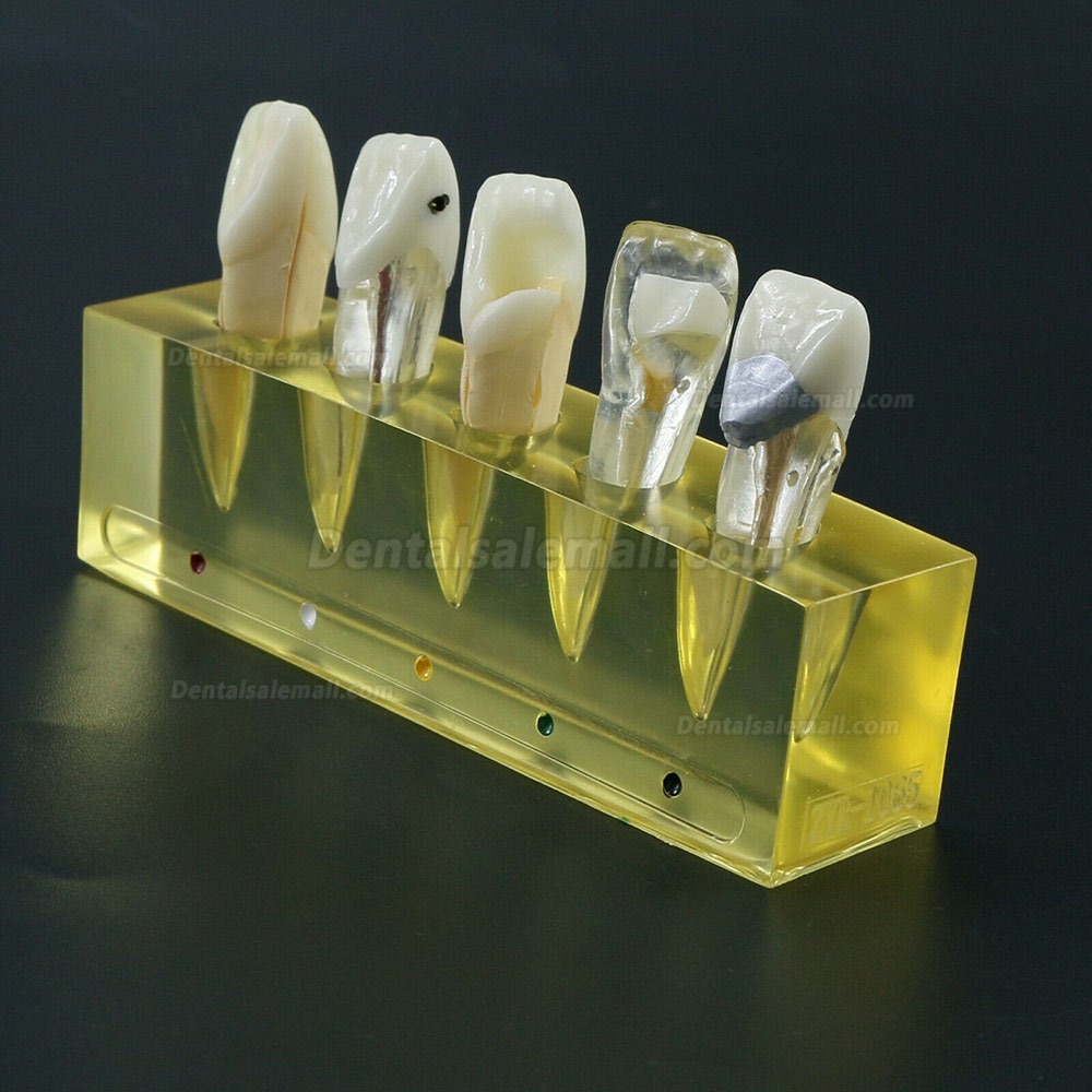 Dental Teeth Model 5Stages Demonstration Endodontic Treatment Root Canal Incisor
