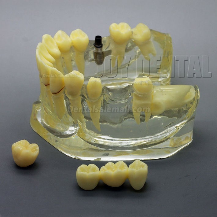 2 Times Enlarged Dental Restoration/ Prothesis/Implant Study model with Bridge