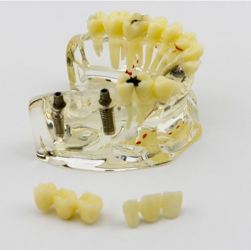 Dental Upper Jaw Implant Model with Bridge and Caries -I 2006