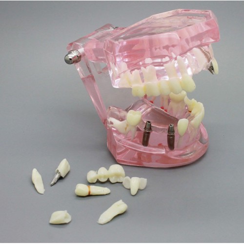 Dental Implant Study Analysis Demonstration Teeth Model with Restoration PINK