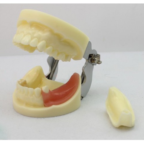 ENOVO Brand Removable Dental Implant Study Model