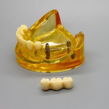 Dental Lower Jaw Implant Model With 2 Implants Bridges 2011