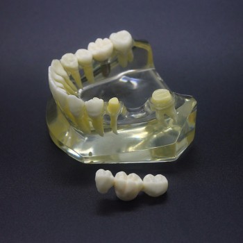 Dental Implant Study Typodont Model Lower Jaw Crown Bridge 2010