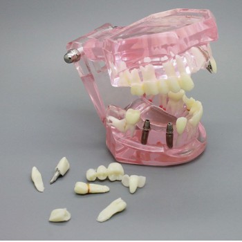 Dental Implant Study Analysis Demonstration Teeth Model with Restoration PINK