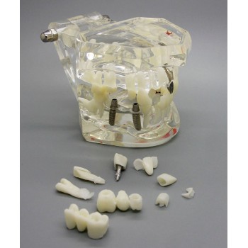 Dental Implant Study Analysis Demonstration Teeth Disease Model with Restoration