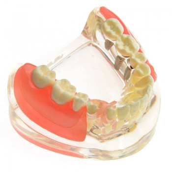 Dental Model Contrast Implant Restoration for Missing Molar Teeth M-6006