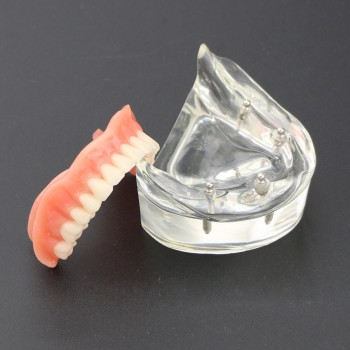 Dental Lower Teeth Demo Study Model 6002 02 Overdenture Inferior 4 Implants