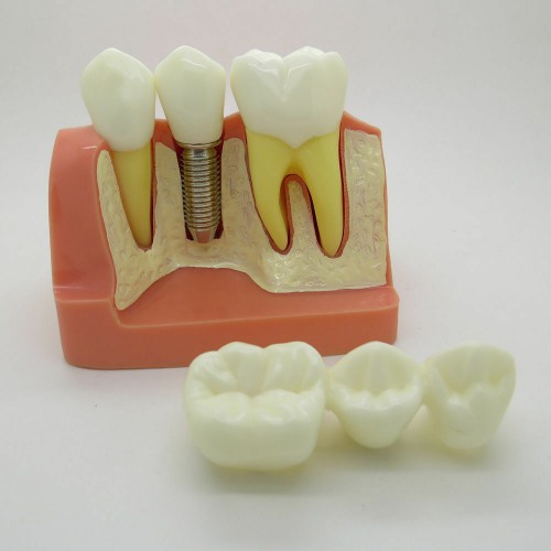 Dental Orthodontics Typodont Implant Analysis Crown Bridge Demonstration Model