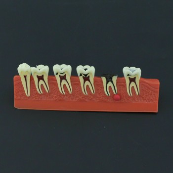 Dental Teeth Disease Model 4 Stages Caries Illustration Typodont 4011 Fit NISSIN