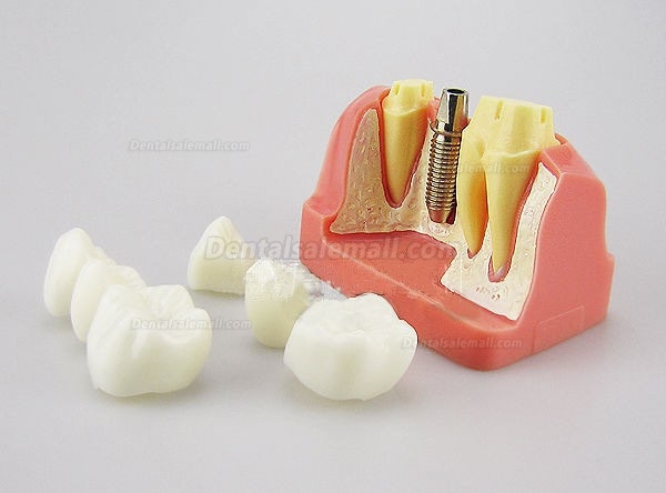 Model Analysis for Dental Implant M2017
