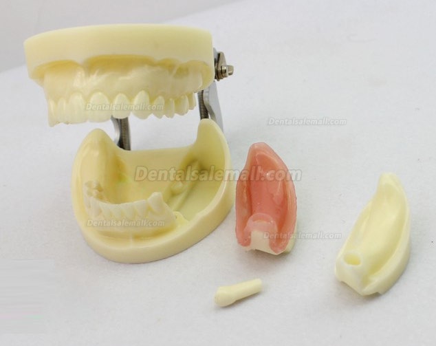 ENOVO Brand Removable Dental Implant Study Model