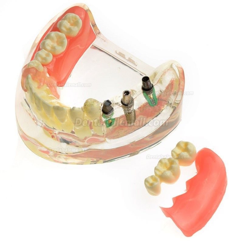 Dental Model Contrast Implant Restoration for Missing Molar Teeth M-6006