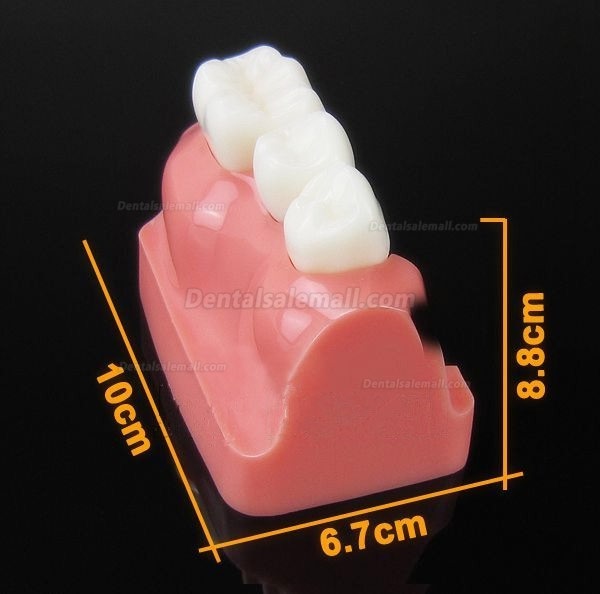 Model Analysis for Dental Implant M2017