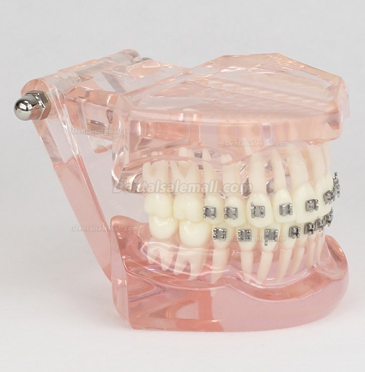 Dental Teeth Malocclusion Correct With Metal Bracket Standard Model M3001