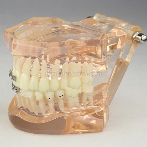 Dental Orthodontic Model with Ceramic Brackets M3009