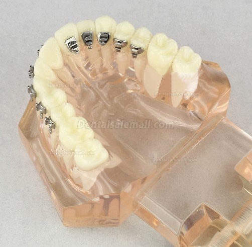 Dental Orthodontic Model with Ceramic Brackets M3009