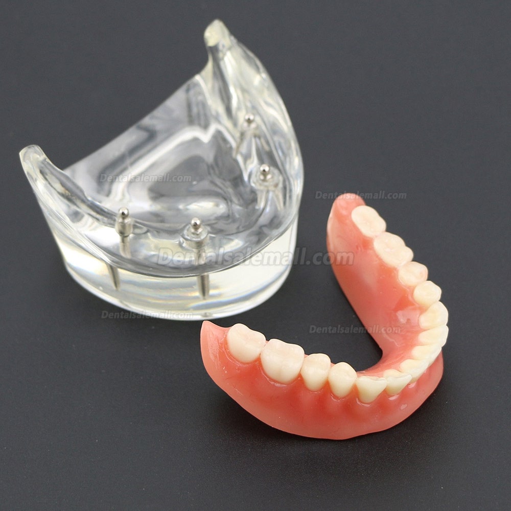 thumbnail image 2 of Alandental Lower Teeth Dental Typodont Model – Overdenture With 4 Implants (Demo Study Model) 2 of 5