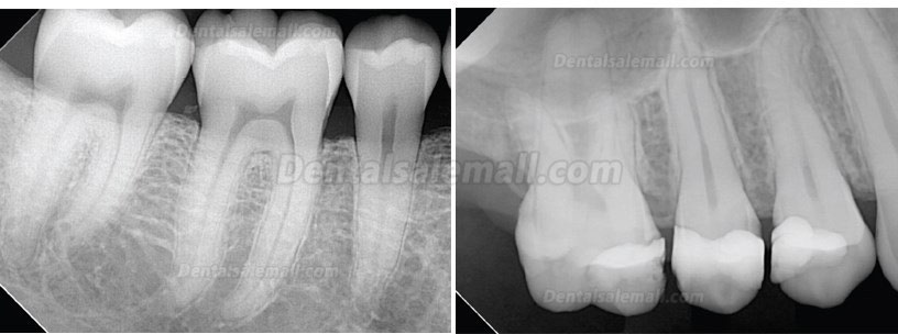High Resolution Digital USB Type Dental X Ray Sensor Rvg High Resolution Digital USB Type Dental X Ray Sensor Rvg