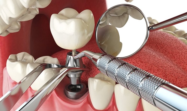 Dental-Implant-pain