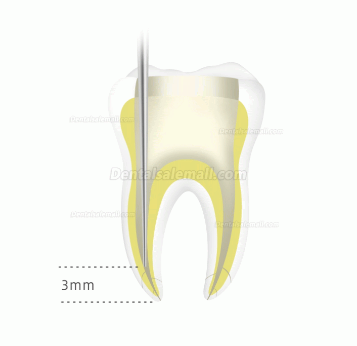Woodpecker Fi-G Dental Wireless Gutta-percha Endo Obturation Gun Endodontic Obturation System
