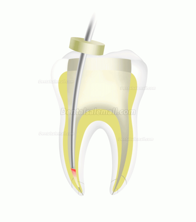 Woodpecker Fi-P Dental Wireless Gutta-percha Endo Obturation Pen