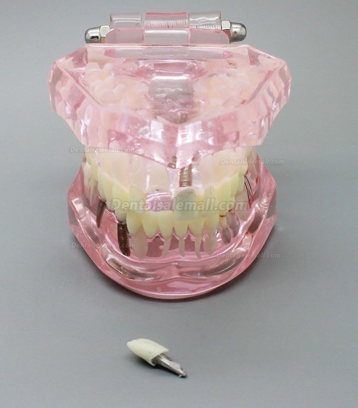 Dental Implant Study Analysis Demonstration Teeth Model with Restoration PINK
