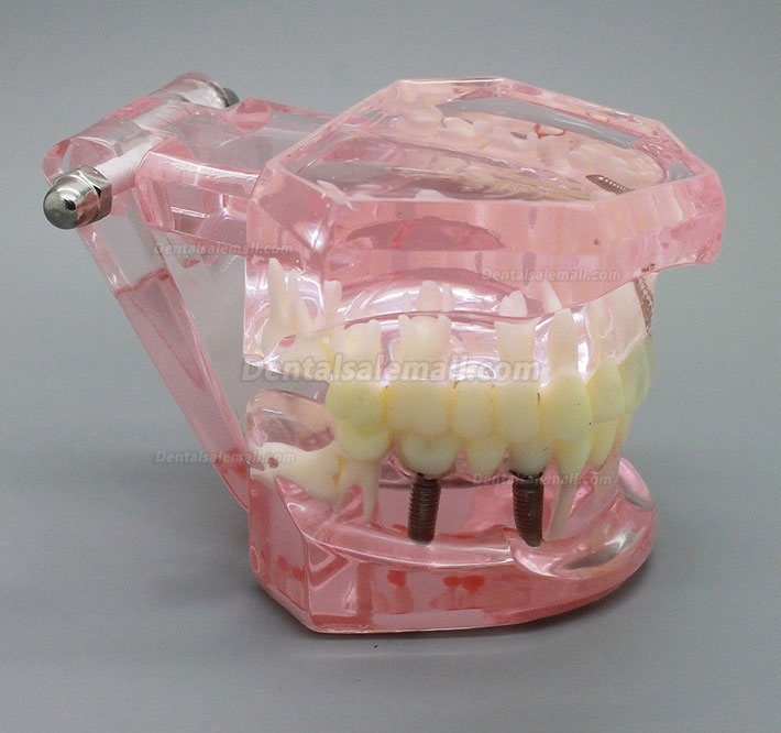 Dental Implant Study Analysis Demonstration Teeth Model with Restoration PINK