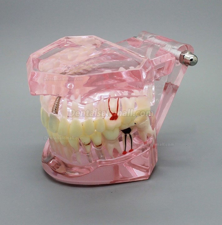 Dental Implant Study Analysis Demonstration Teeth Model with Restoration PINK