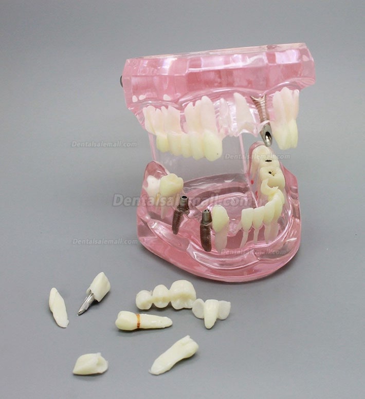 Dental Implant Study Analysis Demonstration Teeth Model with Restoration PINK