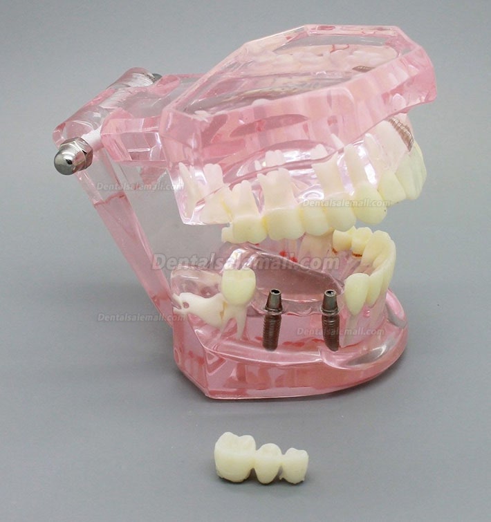 Dental Implant Study Analysis Demonstration Teeth Model with Restoration PINK