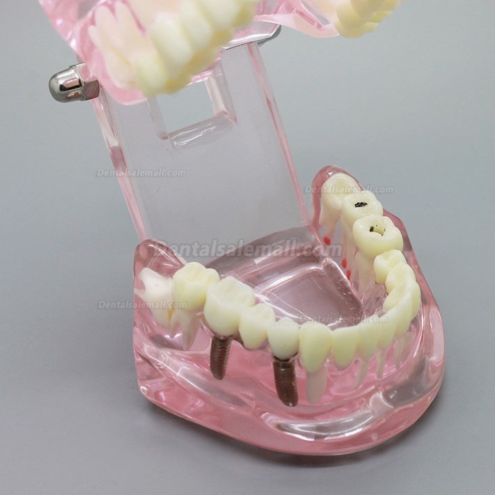Dental Implant Study Analysis Demonstration Teeth Model with Restoration PINK