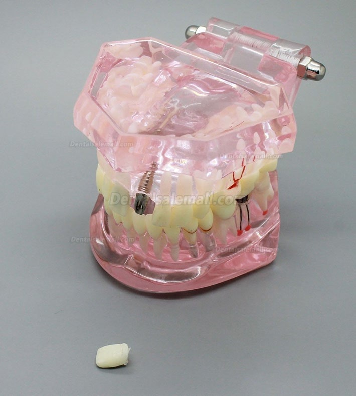 Dental Implant Study Analysis Demonstration Teeth Model with Restoration PINK