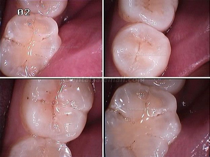 Best CAM Dental 4 Mega Pixel Intraoral Camera SONY CCD Image USB Connection Best CAM Dental 4 Mega Pixel Intraoral Camera SONY CCD Image USB Connection
