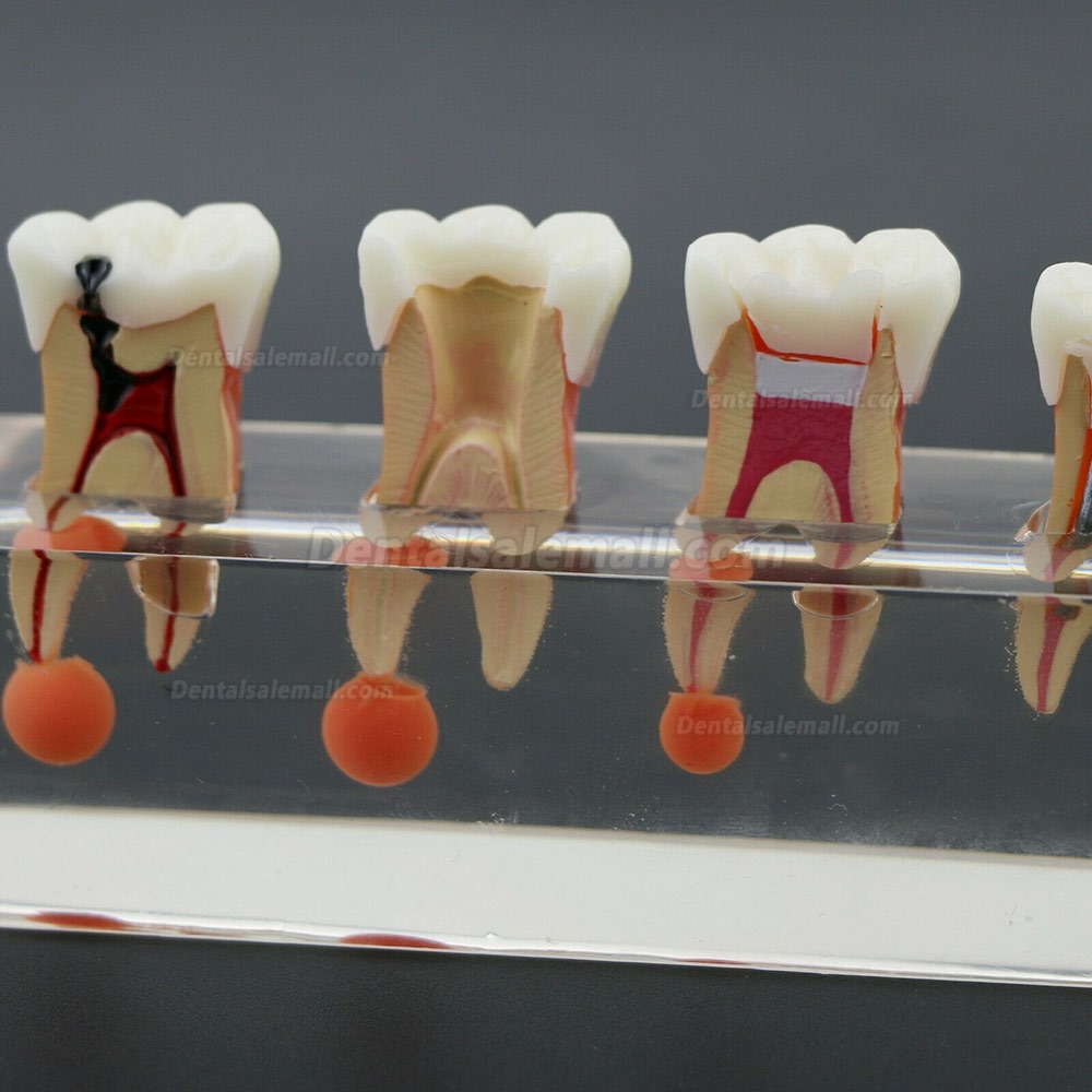 Dental Teeth Model 4-Stage Endodontic Treatment Demonstrates Anatomical M4018