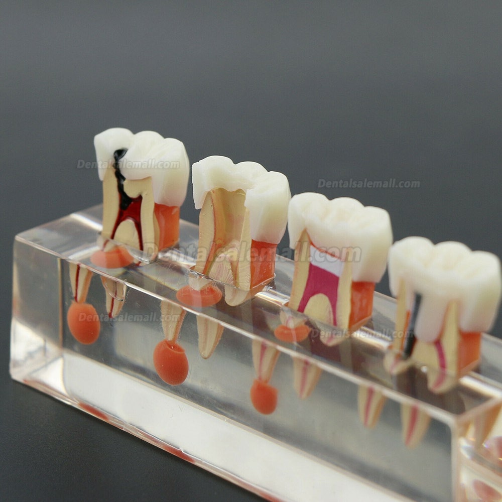 Dental Teeth Model 4-Stage Endodontic Treatment Demonstrates Anatomical M4018-01