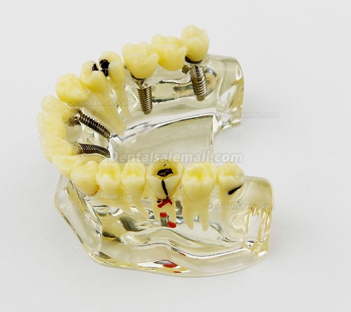 Dental Upper Jaw Implant Model with Bridge and Caries -I 2006