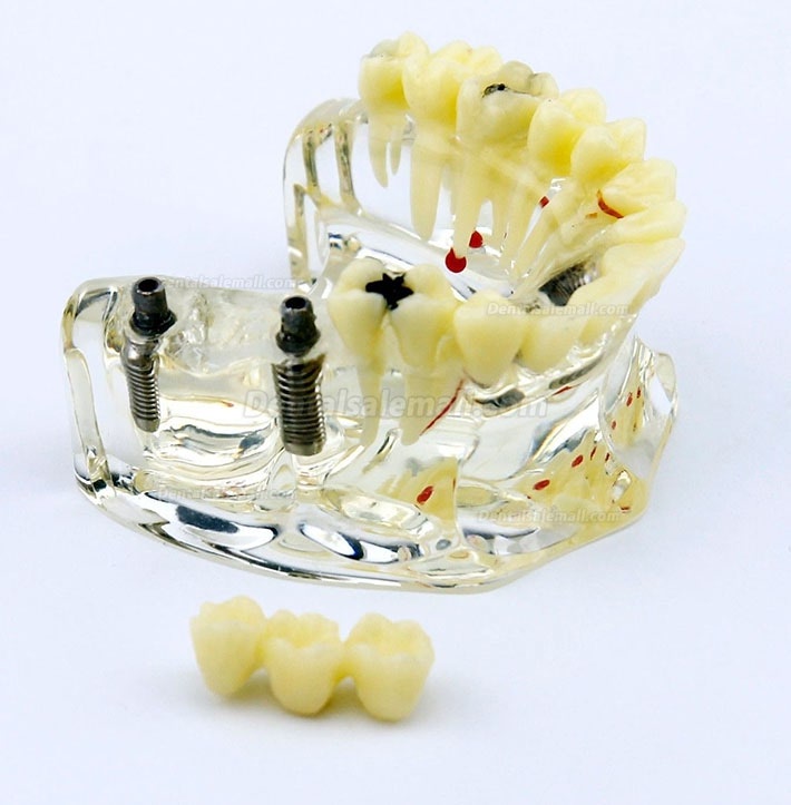 Dental Upper Jaw Implant Model with Bridge and Caries -I 2006