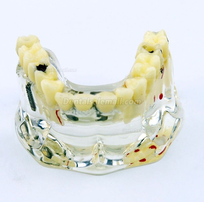 Dental Upper Jaw Implant Model with Bridge and Caries -I 2006