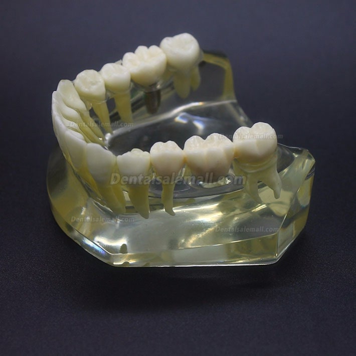 Dental Implant Study Typodont Model Lower Jaw Crown Bridge 2010