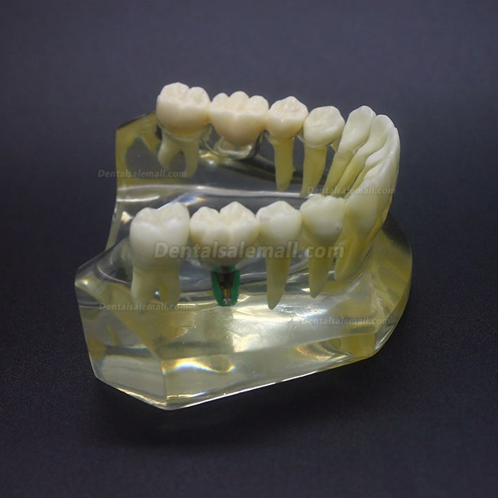 Dental Implant Study Typodont Model Lower Jaw Crown Bridge 2010