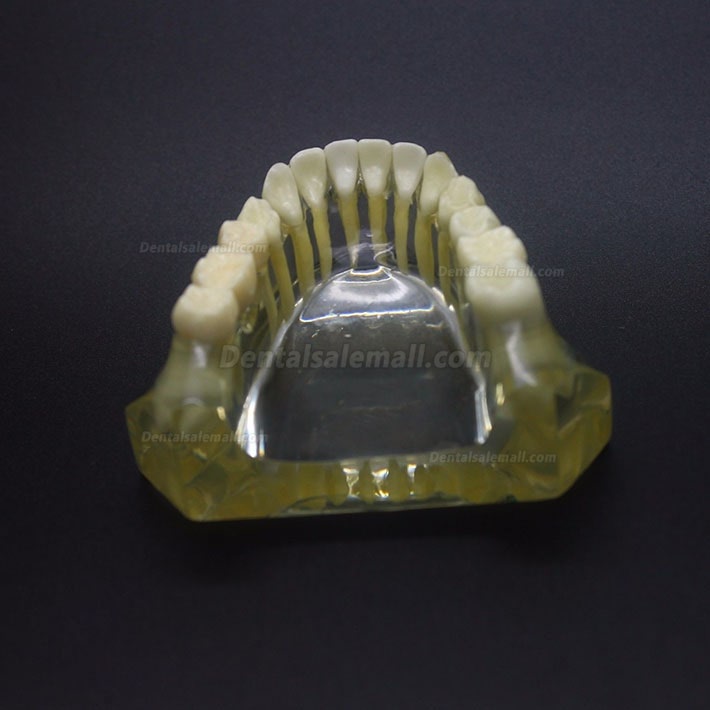 Dental Implant Study Typodont Model Lower Jaw Crown Bridge 2010