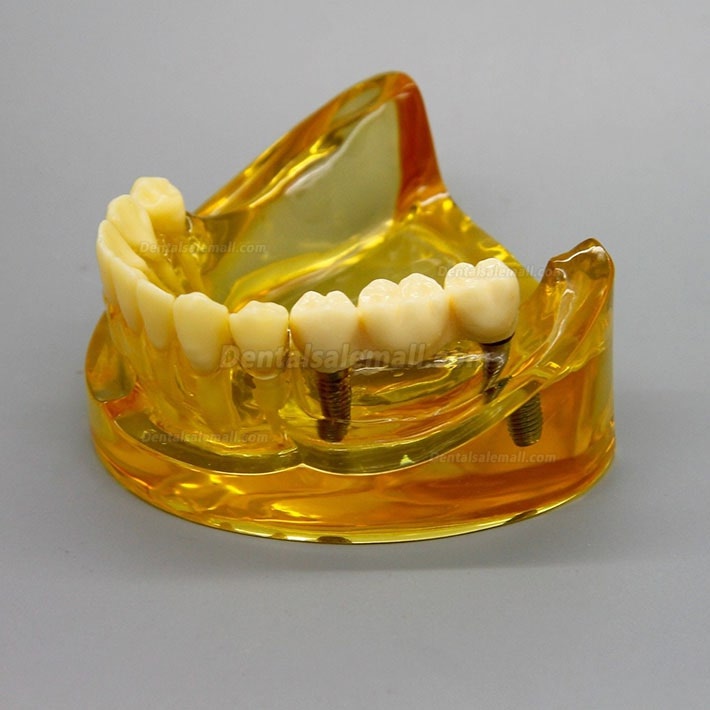 Dental Lower Jaw Implant Model With 2 Implants Bridges 2011