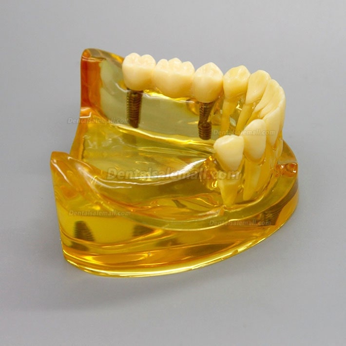 Dental Lower Jaw Implant Model With 2 Implants Bridges 2011