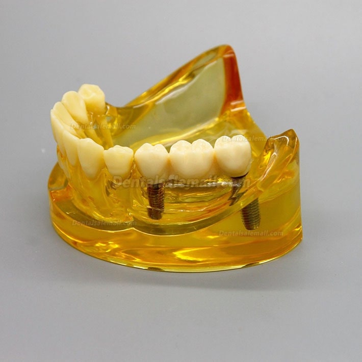 Dental Lower Jaw Implant Model With 2 Implants Bridges 2011