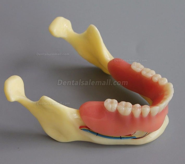 Dental Model #2014 02 - Mandible Implant and Overdenture Demo Model (Yellow)